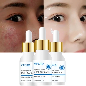 EFERO Acne Fjernelse Creme til Ansigtet Reparation Essensen Whitening Cream Sort Prik Stedet Acne Behandling Serum til Ansigt Pleje Skrumpe Pore